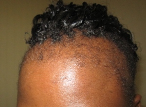 Damaged Afro Hairline